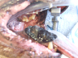 Cancer Of The Tongue