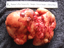 Cancer-Lipoma