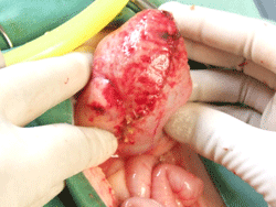 Urinary Bladder Surgery